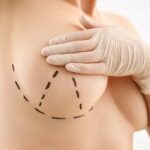 Breast Cancer Awareness: Why Reconstruction Options Matter 4 Female hand in gloves holding breast closeup